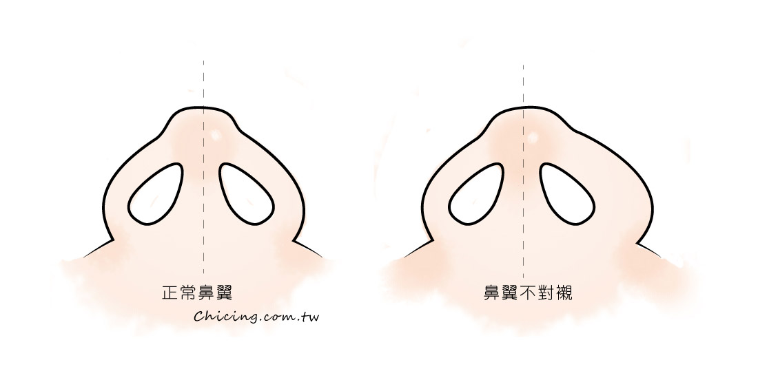 縮鼻翼_鼻翼不對稱