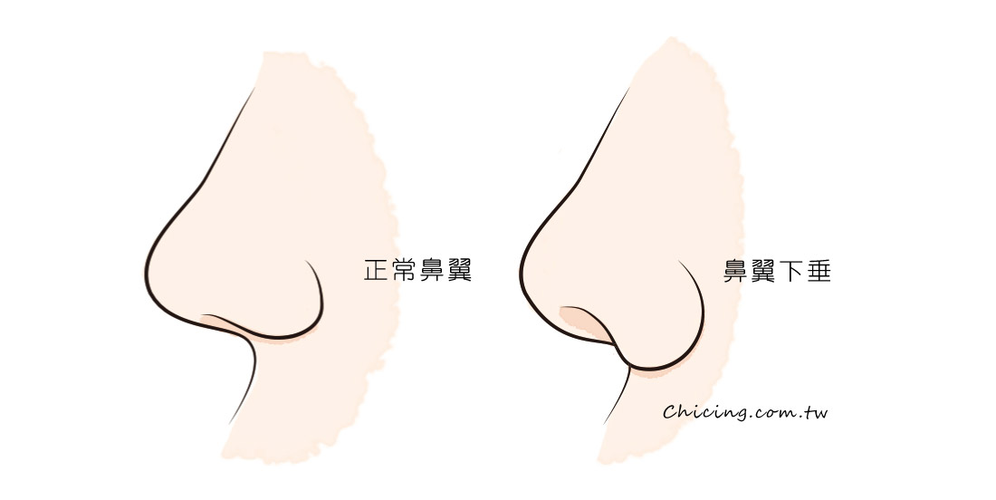 縮鼻翼_鼻翼下垂