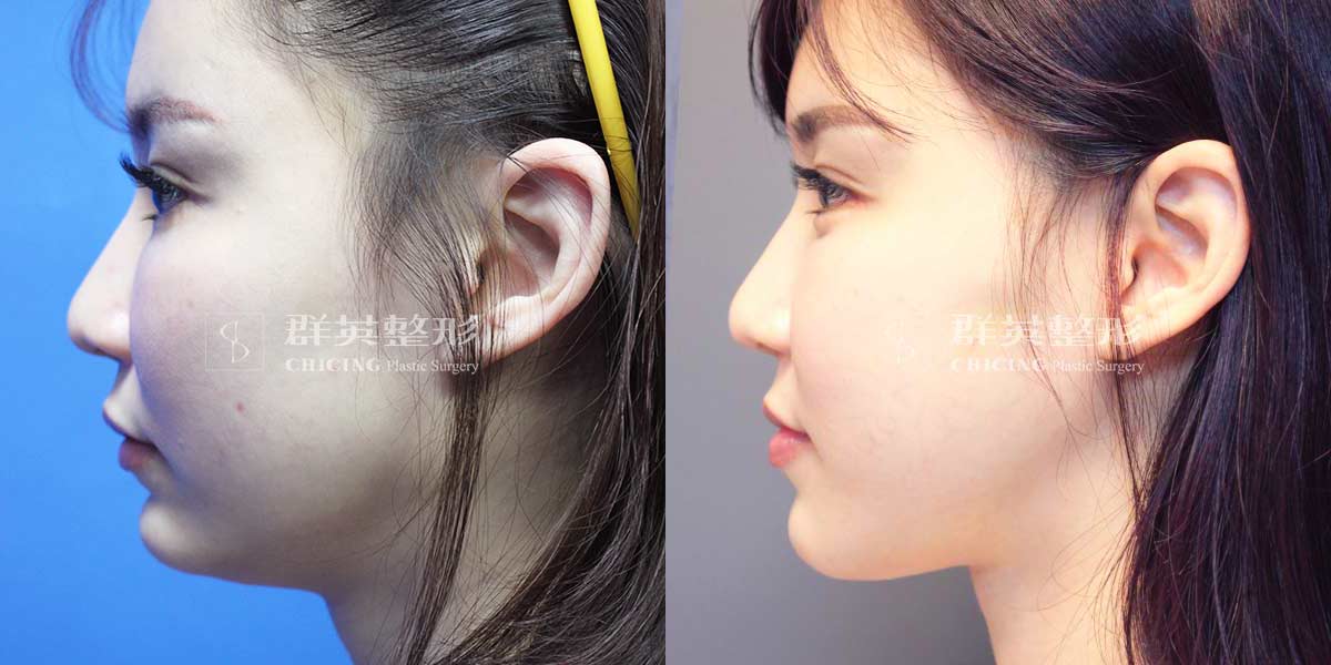 chin surgery