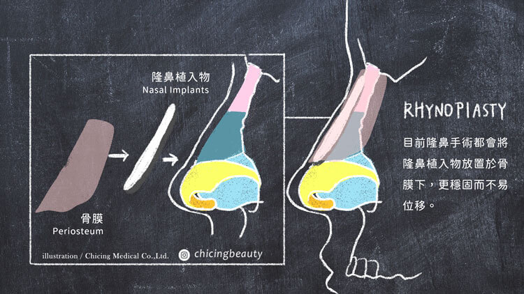 歪鼻_二次隆鼻_隆鼻重修_推薦台北群英整形