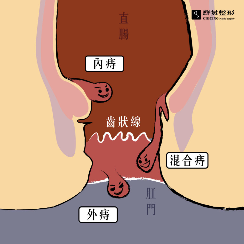 群英整形_黃郁純醫師_混合痔瘡