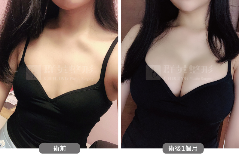 台北群英_黃志宏醫師_魔滴隆乳54