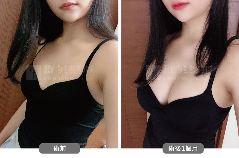 台北群英_黃志宏醫師_魔滴隆乳52