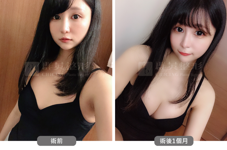 台北群英_黃志宏醫師_魔滴隆乳51