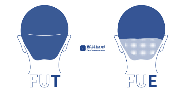 王冠穎醫師_FUE/FUT植髮比較01