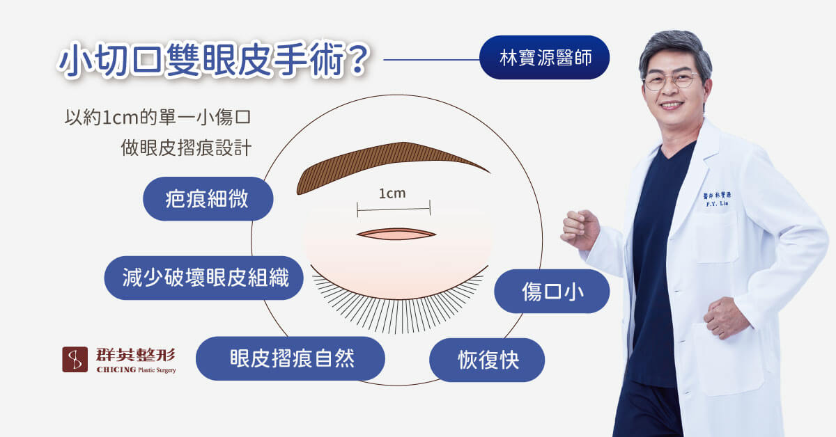 小切口雙眼皮手術_林寶源醫師_高雄群英