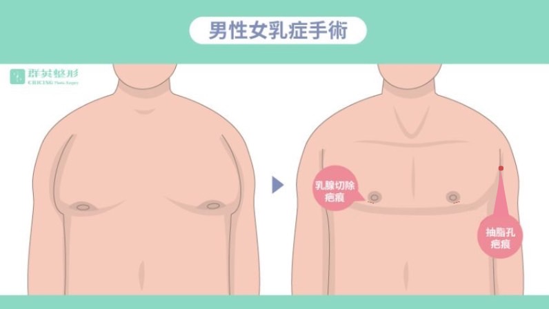 洪章桂醫師_男性女乳症手術